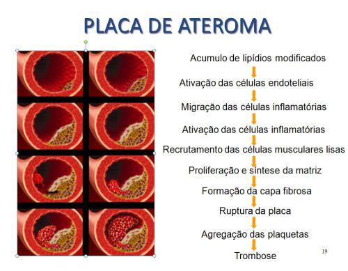 A elevação do nível plasmático de colesterol (acima do normal) pode ser de origem genética e contribui, atualmente, para a ocorrência de 5% dos