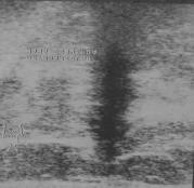 B: Ultra-sonografia mostra área hipoecóica irregular, com forte atenuação posterior. Categoria. Histopatológico: LEC + carcinoma tubular.