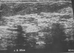 Stefenon CC et al. A B Figura 4. Paciente de 9 anos de idade, assintomática, com distorção arquitetural no quadrante superior externo da mama direita, espículas grossas, centro radiolúcido.