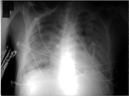 Como pode ser mostrado na Figura 2 e na radiografia do dia 09/11 (Figura 4), representando a fase aguda da doença, o paciente evoluiu com piora progressiva, com insuficiência ventricular esquerda