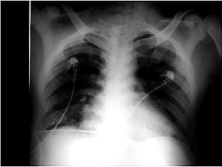 Figura 4 - Radiografia de tórax realizada em 09/04/08 demonstrando congestão pulmonar intensa. A RMN foi realizada no dia 11/11 e selou o diagnóstico de miocardite aguda fulminante.