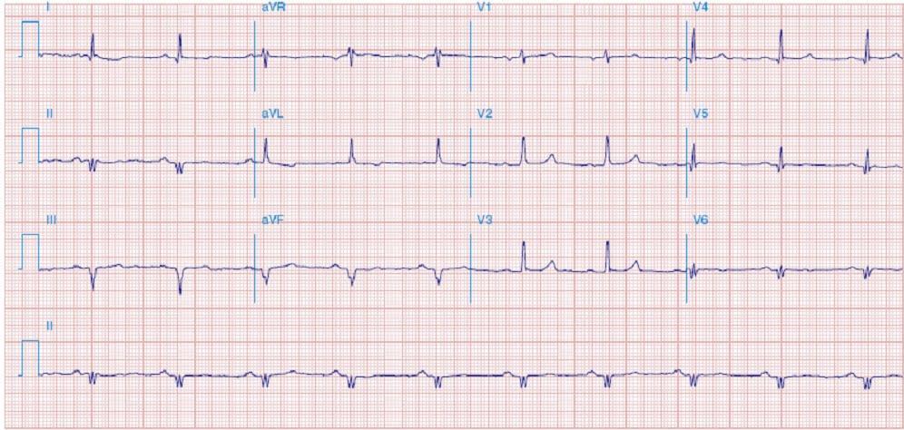 INFARTO