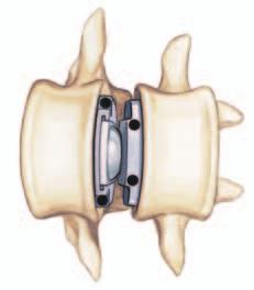 Conceito de tratamento com Prodisc O objetivo de tratamento da prótese de disco intervertebral, Prodisc Lombar, é o de restaurar o funcionamento dinâmico normal da coluna vertebral e também