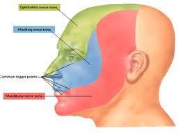 Geralmente se inicia na segunda ou terceira divisões do nervo trigêmeo Em <5% dos pacientes a primeira divisão é afetada A dor nunca atravessa o outro lado da face A dor é intensa e