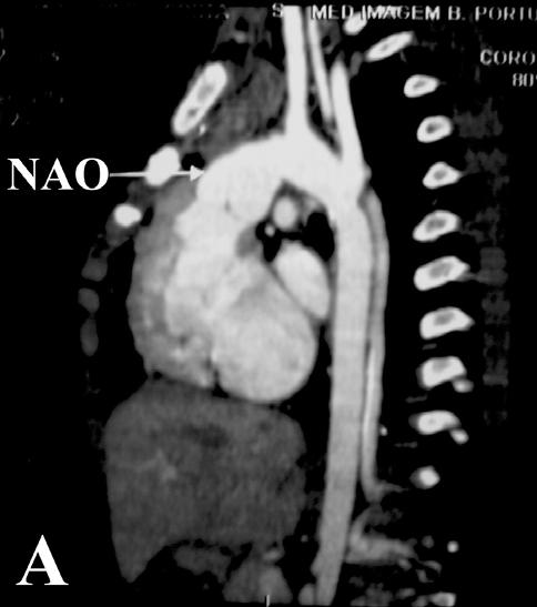 morfologia da aorta na maioria dos pacientes (Figura 4). Fig.