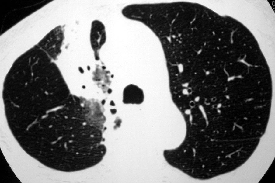 Lesão Pulmonar Induzida pela Radiação Pneumonite 1 a 3 meses após RDT sintomas antes das alterações RX dispnéia (93%), tosse