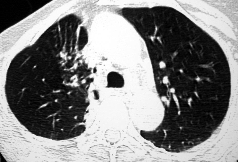 Lesão Pulmonar Induzida pela Radiação Fibrose síndrome clínica (6 a 24 m) pode se manifestar sem a fase aguda
