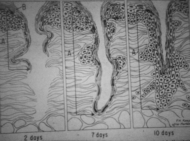 Figura 3 Epitelização de ferida: observa-se na figura esquemática a migração de células epiteliais da superfície para a profundidade da ferida e em seguida a proliferação dessas células até a