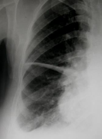 pulmonar -