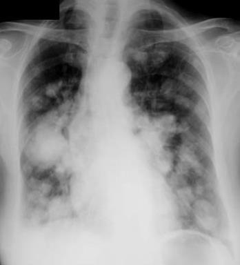 Diminuição transparência pulmonar - Opacidades elementares Número e localização única Localização no campo