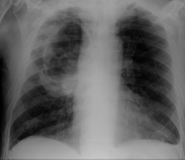 Aumento transparência pulmonar -