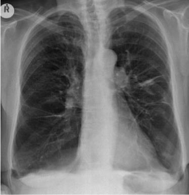 Aumento transparência pulmonar - Enfisema pulmonar Sinais indiretos