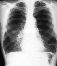 Aumento transparência pulmonar - Enfisema pulmonar Sinais indiretos HTP Dilatação das a.