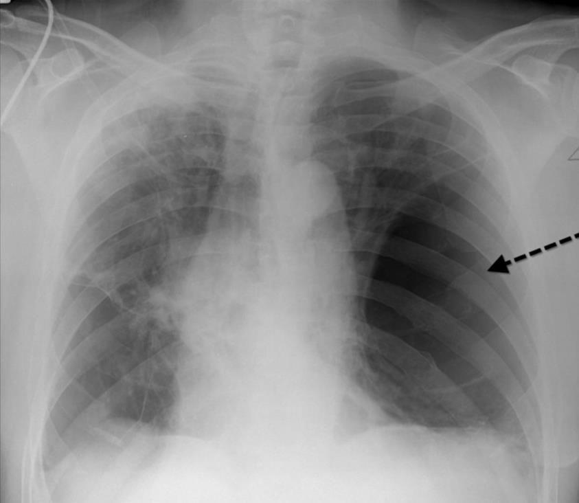 Aumento transparência pulmonar - Enfisema