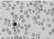 Recomendações do ICSH SV Inclusões eritrocitárias ERITROBLASTOS -São precursores eritrocitários descritos normalmente apenas como eritroblastos quando encontrados no sangue periférico.