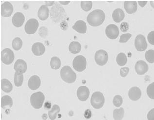 Recomendações do ICSH Plaquetas As plaquetas gigantes podem ser maiores que as hemácias (10 20 mm) e podem ser identificadas pelos alarmes dos equipamentos