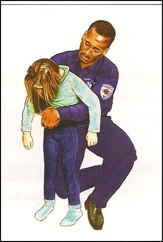 .. Adulto: O comissário se posiciona de lado e atrás da vítima para iniciar as compressões abdominais (Manobra de Heimlich).