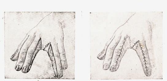 Os dedos foram separados ao longo da linha de união, resultando urna superfície cruenta em cada dedo.