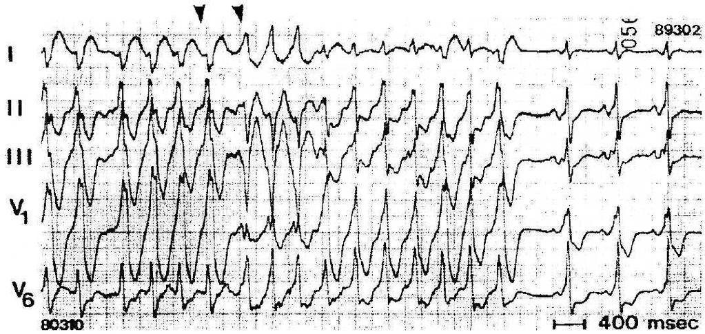 18 Figura 7 Fibrilação atrial em paciente portador de múltiplas vias anômalas Cinco derivações eletrocardiográficas simultâneas mostrando dois padrões distintos de pré-excitação ventricular durante