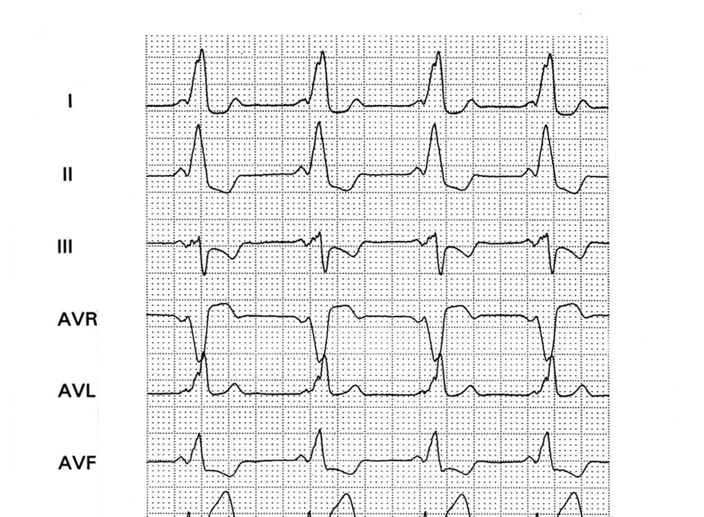 20 Figura 8 ECG de portador de WPW por via anômala anteroseptal Registro