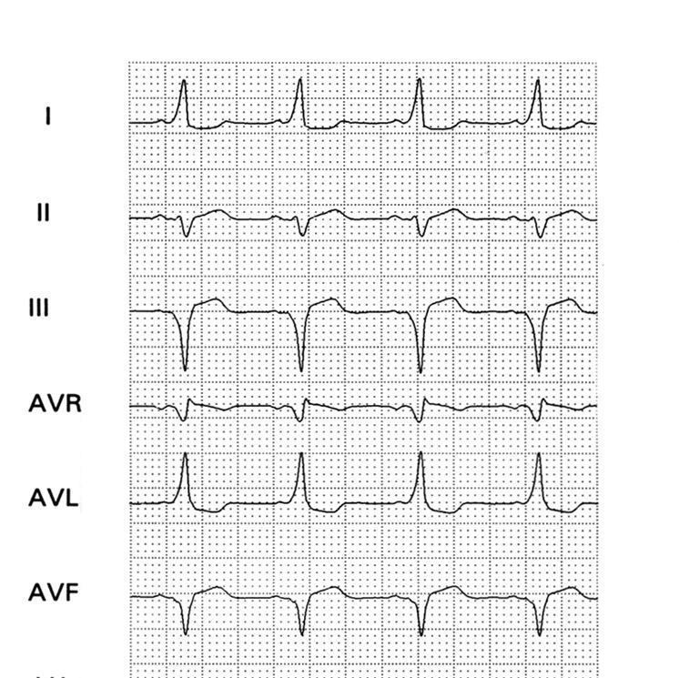 21 Figura 9 ECG de portador de WPW por via medioseptal Registro eletrocardiográfico de 12