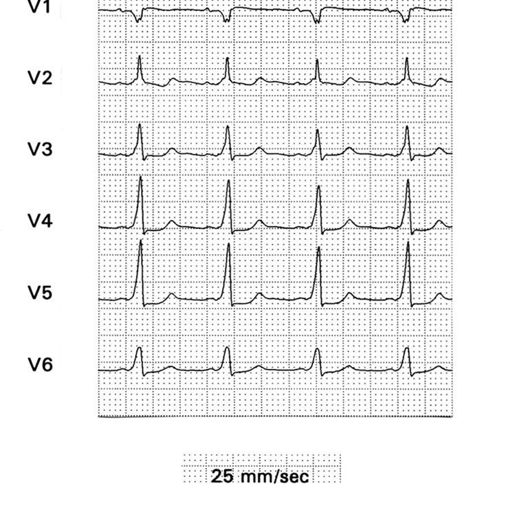 onda delta discordante em D2, D3 e avf, além de transição precoce do QRS de negativo em V1