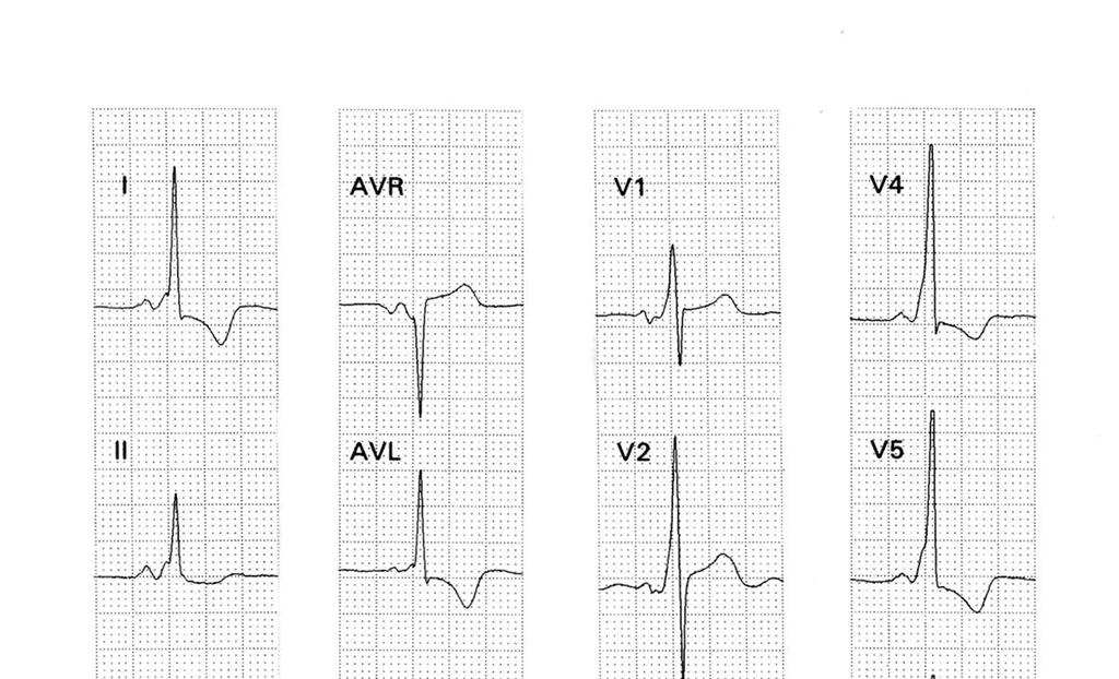 27 Figura 15 ECG de portador de WPW por via posterior esquerda Registro eletrocardiográfico de 3 canais simultâneos.