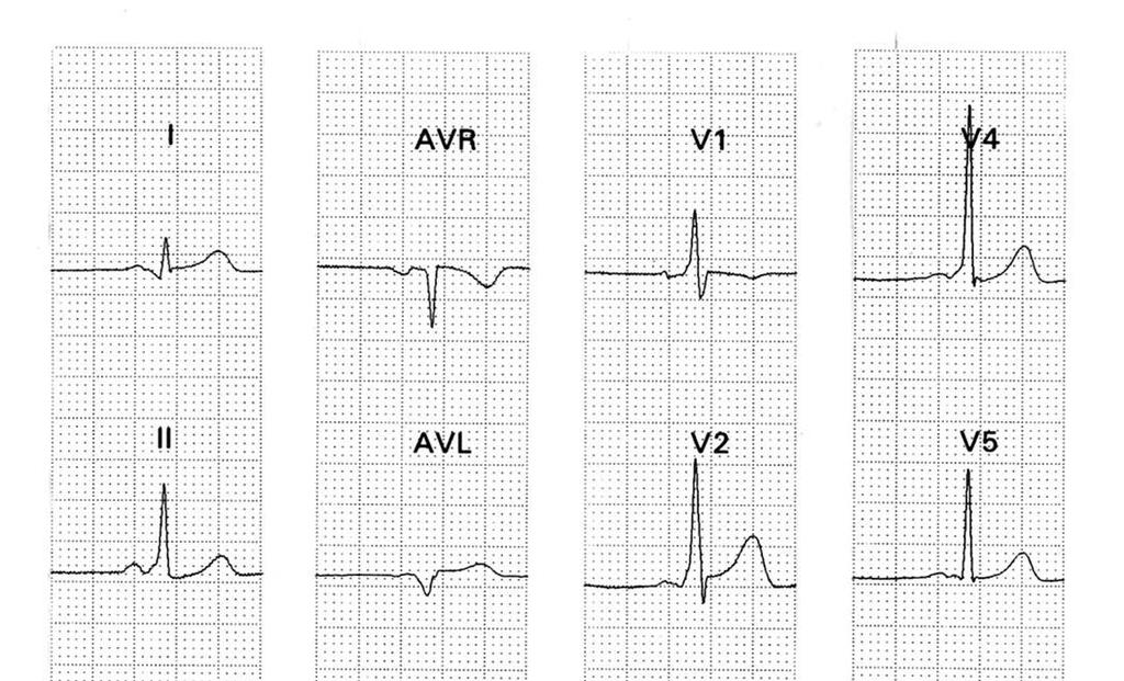 29 Figura 17 ECG de portador de WPW por via anterior esquerda Registro eletrocardiográfico de 3 canais simultâneos A localização anterior esquerda da