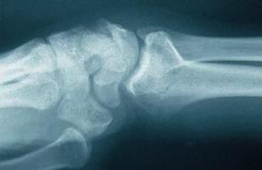 INTRODUÇÃO INDICAÇÕES Indicado para a osteomia e a de fraturas intra e extra-articulares complexas do rádio distal e de outros pequenos ossos.