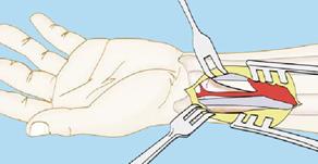 . Posicione o Paciente Disponha o paciente na posição supina com a mão e o braço em mesa cirúrgica preferencialmente translúcida para a obtenção de imagens