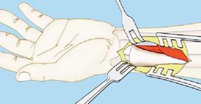 Abordagem Faça uma incisão longitudinal e ligeiramente radial ao tendão do músculo flexor radial do carpo (FRC).