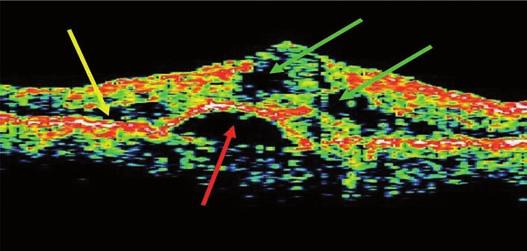 802 Avaliação da tomografia de coerência óptica em pacientes portadores de degeneração macular relacionada à idade Quadro 3.