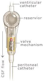 1. DESCRIÇÃO DA TECNOLOGIA As válvulas do sistema de derivação para tratamento de hidrocefalia foram inicialmente criadas em 1949 e, desde então, inúmeras válvulas diferentes foram desenvolvidas e,