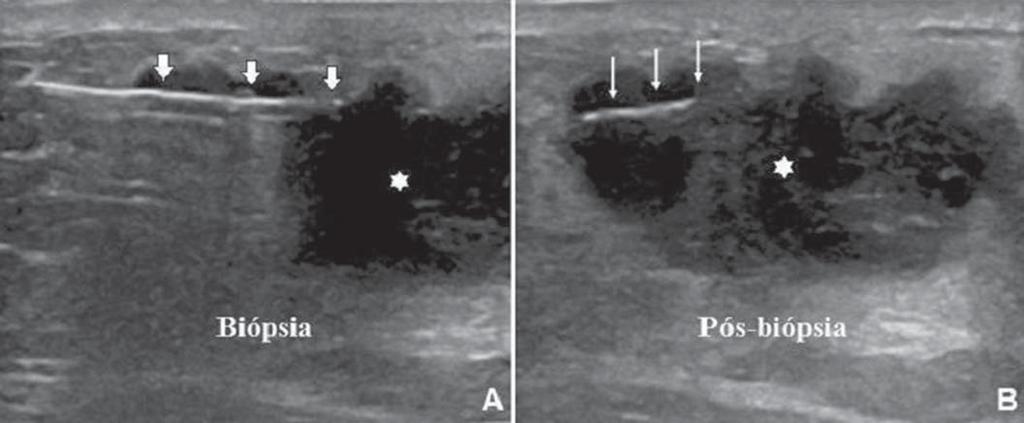 Figura 4. Artefato de gás pós-disparo. A: Excursão da agulha (setas largas) dentro do nódulo (asterisco) durante a biópsia.