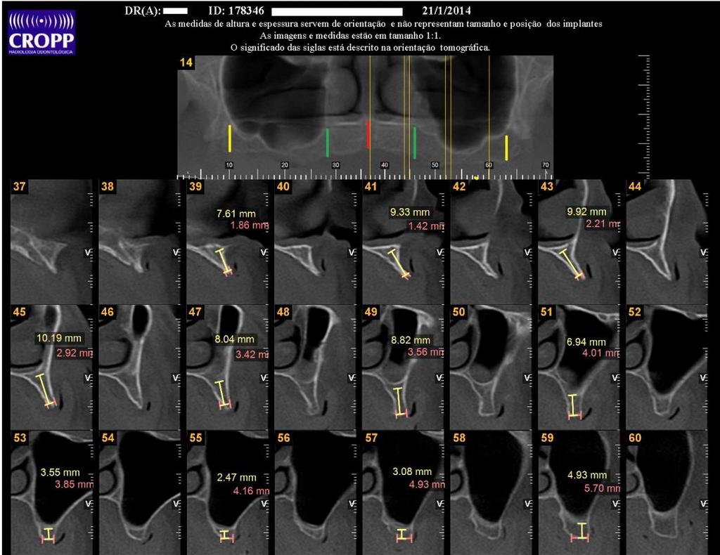 29 Figura 1- Tomografia de maxila.