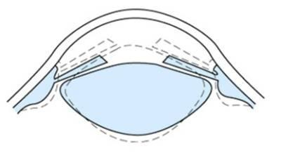 Cristalino Estrutura transparente, biconvexa, que se encontra suspensa pelas fibras da zonula, atrás da pupila e da íris.