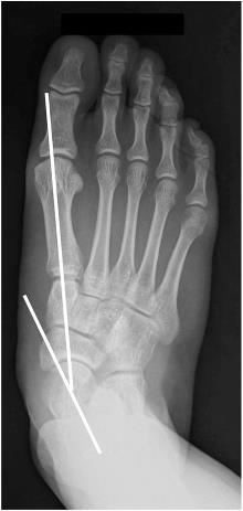 a) b) c) d) astrágalo-escafóideia verificou-se maior grau de eversão e adução (do escafóide relativamente ao astrágalo), entre a posição de flexão plantar e dorsiflexão e inversão e eversão, e maior