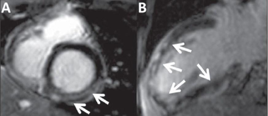 Imagem (C) demonstrando o planejamento Quatro câmaras eixo longo e o planejamento da Via de saída do ventrículo direito (VSVD).