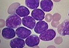 Leucemia linfóide (ou linfocítica ou linfoblástica) Os linfócitos em desenvolvimento não amadurecem e se multiplicam em excesso Encontram-se
