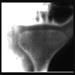 ANATOMIA Côndilo Mandibular O côndilo mandibular possui anatomia variável Convexo no sentido A-P e levemente convexo