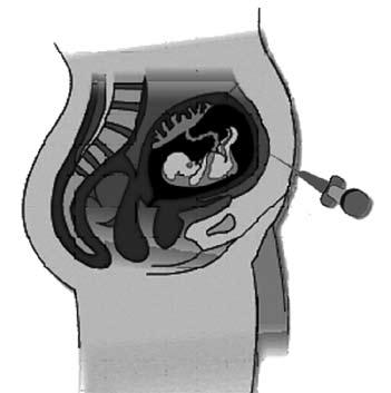 4 PROVA DE BIOLOGIA/QUÍMICA - 2 a Etapa QUESTÃO 01 Analise esta figura, em que está representado um procedimento de coleta de células presentes no líquido amniótico: O procedimento ilustrado permite
