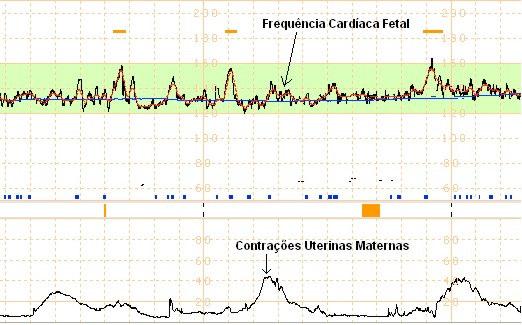 2 Metodologia Figura 1: sinais de FCF e UC de uma CTG.