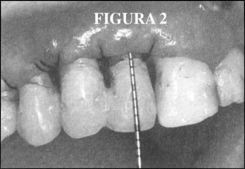 alcançado por meio de osteotomia / osteoplastia na técnica previamente escolhida para essa região ou seja com