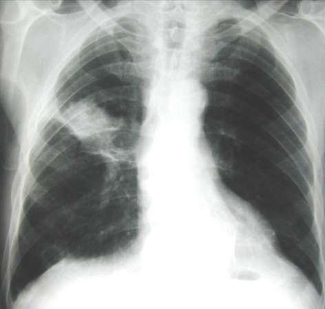 Nódulo pulmonar solitário Carcinoma pulmão Massa com 6 cm, contornos irregulares e
