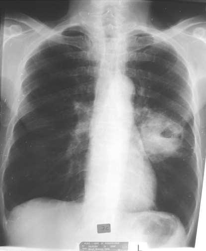 Nódulo pulmonar solitário Cavitação Macronódulo no andar médio do CP esquerdo heterogéneo por cavitação com parede