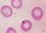 pequeno ou tamanho normal, isto é, anemias macrocítica, microcítica e