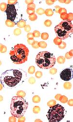 LEUCOGRAMA Número total de glóbulos brancos (avaliado em mil por mm3) e sua contagem diferencial no sangue periférico Interpretação criteriosa Baixa especificidade Considerar contexto clinico