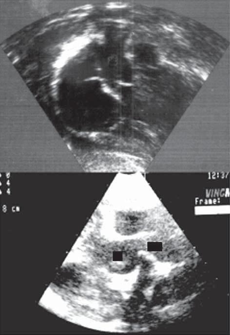 Tabela II - Principais achados em quatro casos de origem anômala de uma artéria pulmonar da aorta ascendente Caso Idade Sexo Anomalia Anomalia Apresentação Diagnóstico Tratamento Seguimento Principal