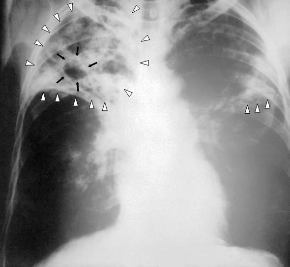 Figura 8 Infecção pulmonar causada pelo bacilo Mycobacterium tuberculosis Fonte: Wikipédia A Gripe A influenza, também conhecida como gripe, é uma das doenças respiratórias que mais acometem o homem.