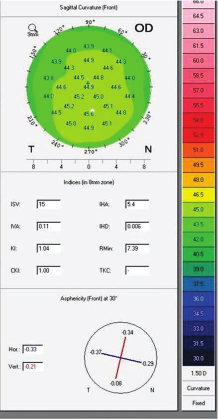 índices de inteligência artificial do Nidek corneal navigator identifica normalidade em OD (NRM=62.2%; OTH=32.8%; KC, KCS and PMD=0%) e ceratocone em OE (KC=99%, KSI=13.